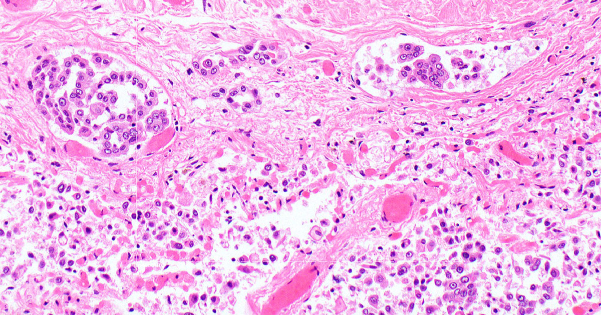 Pathology Report Excerpt Confirming Mesothelioma Diagnosis